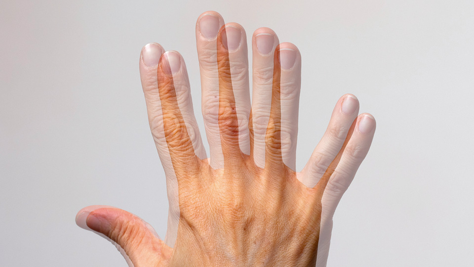 Diplopia