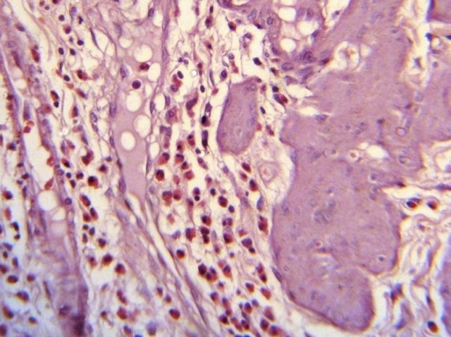 Image: “Histopathology of eosinophilic cholecystitis” by K C Geetika & Talwar OP, Journal of Pathology of Nepal (2014), via Wikimedia Commons (https://commons.wikimedia.org/wiki/File:Histopathology_of_eosinophilic_cholecystitis.jpg), licensed under Creative Commons Attribution 4.0 International (CC BY 4.0) – https://creativecommons.org/licenses/by/4.0/