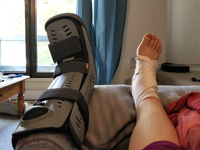 Ruth Hartnup from Vancouver, Canada Woe is me Diagnosis: one broken ankle, one sprained ankle