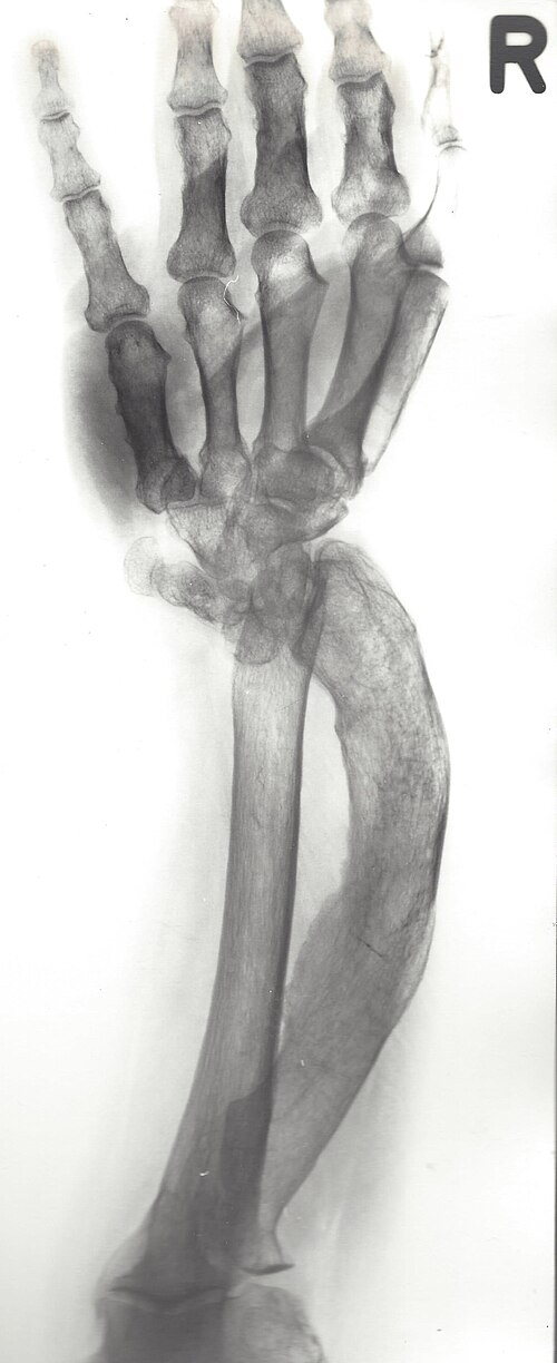 Image: Anteroposterior radiograph of a supinated forearm showing Madelung deformity of the distal radius. Original X-ray from the Radiology Institute of the Municipal Hospital Kiel (Röntgeninstitut des Städtischen Krankenhauses Kiel), taken in 1986 and first uploaded to Wikimedia Commons (file name: Madelung_(re).jpg). Credited to the Radiology Institute of the Municipal Hospital Kiel, with Wikimedia Commons as the source, and used under the Creative Commons Attribution-ShareAlike 3.0 Unported (CC BY-SA 3.0) licence.