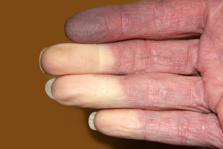 Raynaud’s Phenomenon physical therapy