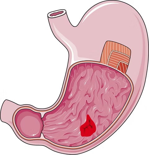 Image: “Stomach ulcer – digestive system” (SMART-Servier Medical Art) by Laboratoires Servier, via Wikimedia Commons (https://commons.wikimedia.org/wiki/File:Digestive_system_-_Stomach_ulcer_--_Smart-Servier.png), licensed under Creative Commons Attribution-ShareAlike 3.0 Unported (CC BY-SA 3.0, https://creativecommons.org/licenses/by-sa/3.0/).