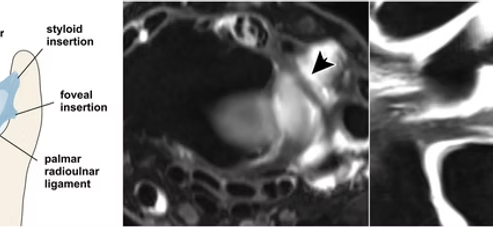 Triangular Fibrocartilage Complex (TFCC) Injuries