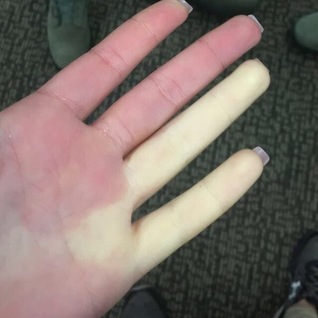 Raynauds fenomen