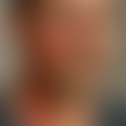 Lyme Disease (Lyme borreliosis)