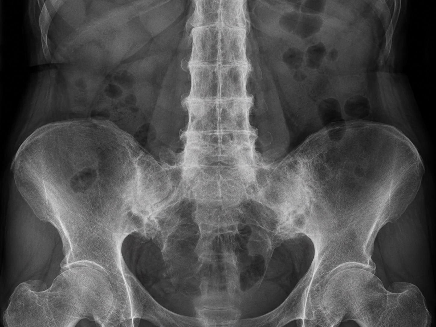 Axial spondyloarthritis and ankylosing spondylitis
