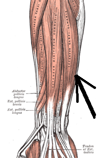 Extensor Carpi Ulnaris (ECU) Subluksasjon
