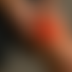 Quadriceps Contusion