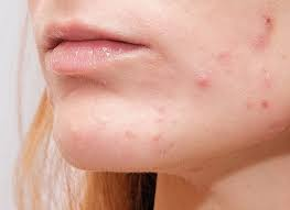 Kan stress føre til kviser?