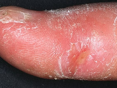 Scleroderma (Systemic Sclerosis)