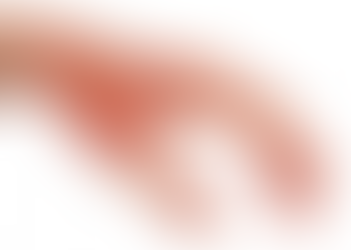 Hva skal jeg gjøre om jeg brenner meg?