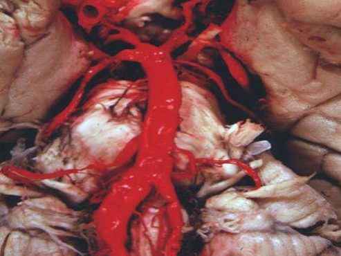 Cerebral småkarsykdom