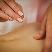 young-woman-getting-acupuncture-treatment-in-thera-2023-11-27-05-05-21-utc.jpg