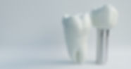 implant-dentar.jpeg