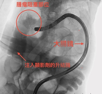 大腸金屬支架置放中。