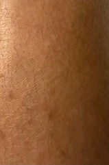 pic body Extreme dryness and Hyperpigmentation-AFTER.jfif