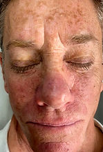 pic SunDamage BEFORE