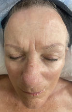 pic-client Rosacea-AFTER