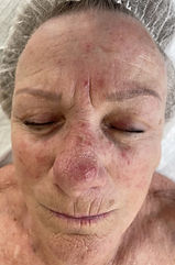 pic-client Rosacea AFTER