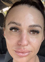 pic-client ACNE AFTER Chemical Peels _ed