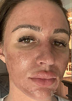 pic-client ACNE-HYPERPIG Chemical Peels