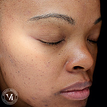 Acne, Scarring _ PIH_02_edited.jpg