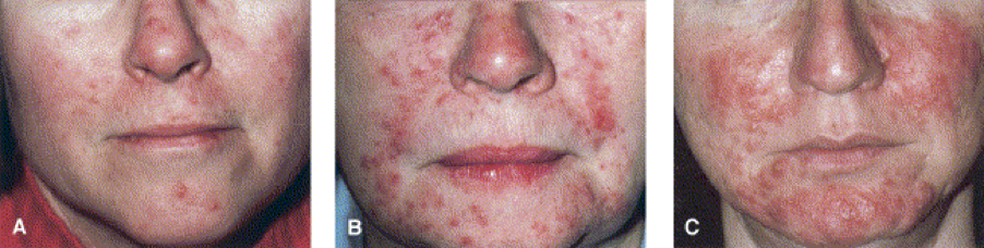 Papulopustular Rosacea (PPR)