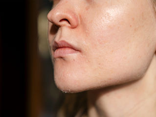 The Profhilo Glow: Why Malaysians Are Embracing Bioremodeling for Radiant Skin