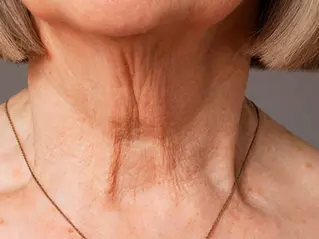 Most of us spend so much time caring for our face — serums, facials, sunscreen — but the neck quietly gets forgotten. Yet, it’s often the first place that shows signs of aging. Fine lines, rough texture, and dullness can creep in even when your face still looks radiant.                   During my recent Skinvive neck training, I felt genuinely inspired to see how beautifully this treatment can rejuvenate the neck area. So, let’s talk about it — because glowing skin shouldn’t stop at the jawline. 