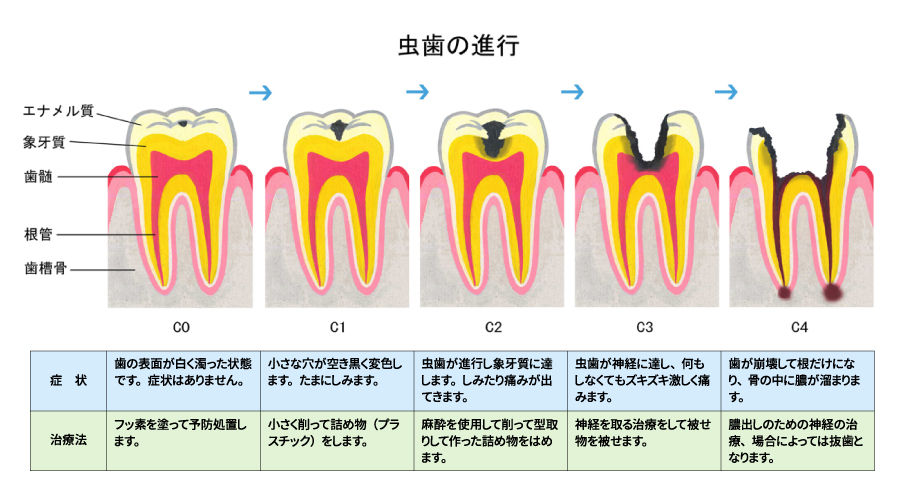 虫歯の進行.jpg
