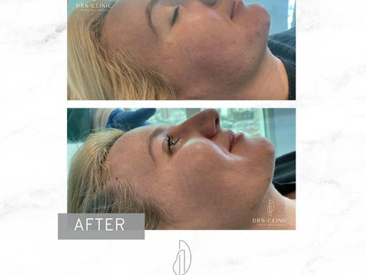 Peeling Kimik