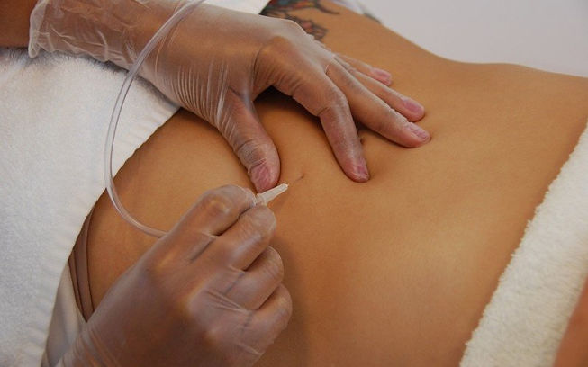 Carboxytherapy-in-Chicago.jpeg
