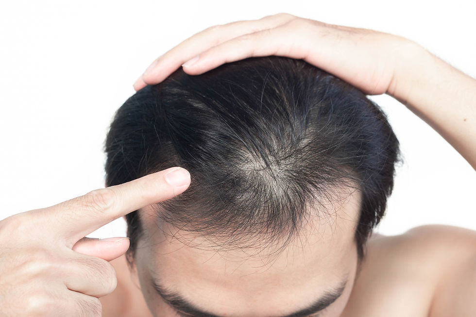 年青時期髮線後移原因