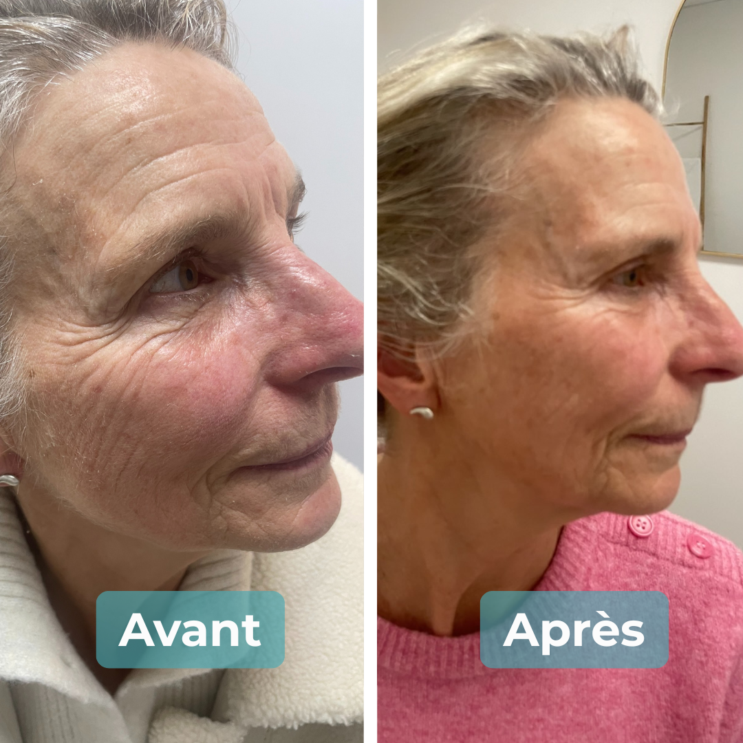 Avant/Après soin anti-âge MAbeautyplus
