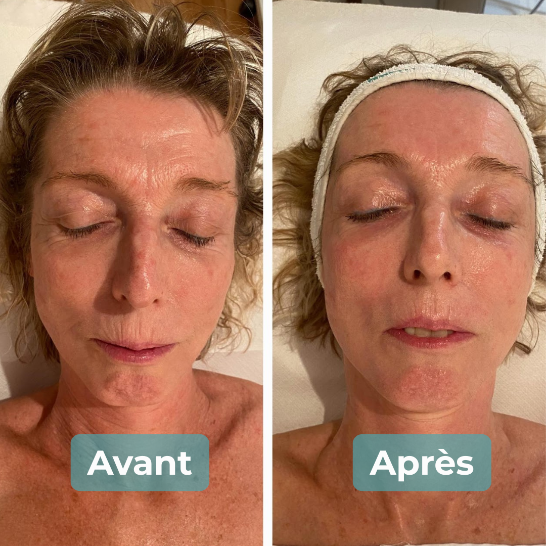 Avant/Après soin anti-âge MAbeautyplus