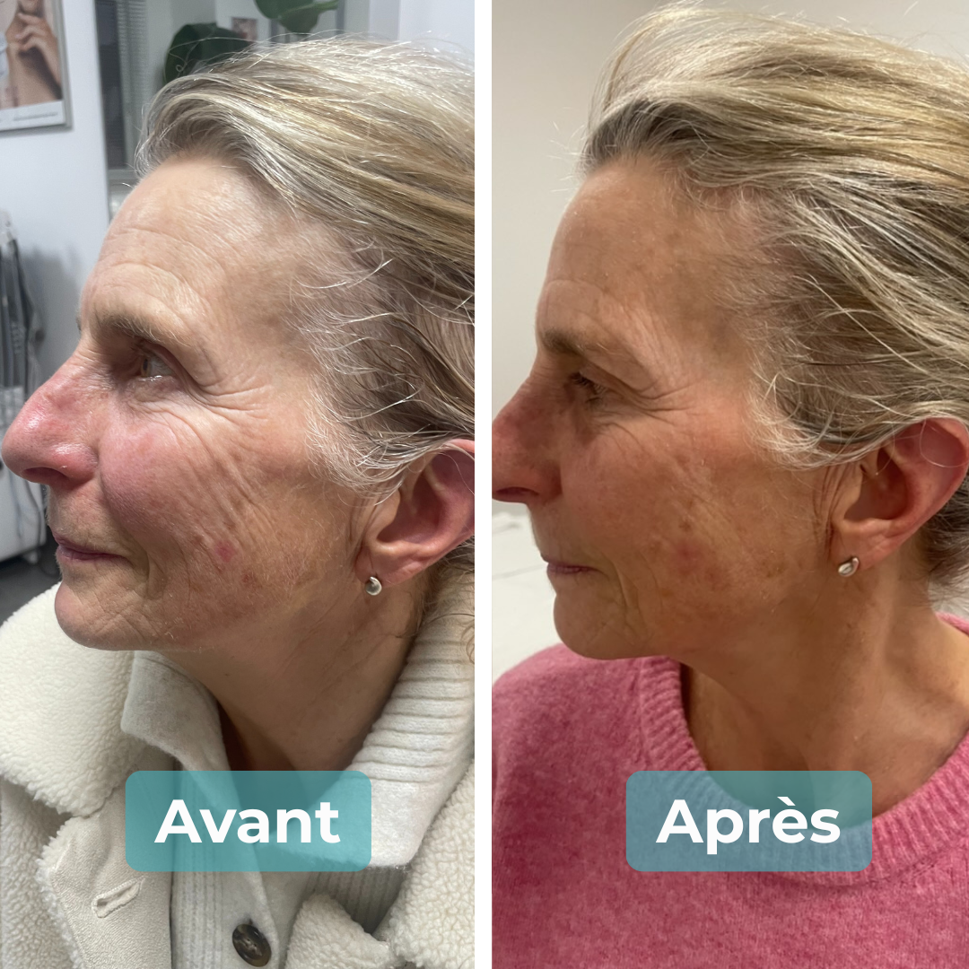 Avant/Après soin anti-âge MAbeautyplus