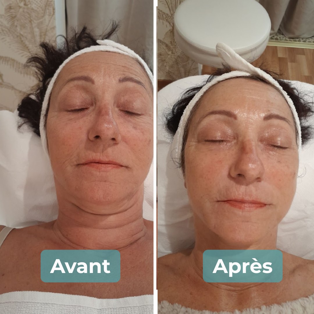 Avant/Après soin anti-âge MAbeautyplus