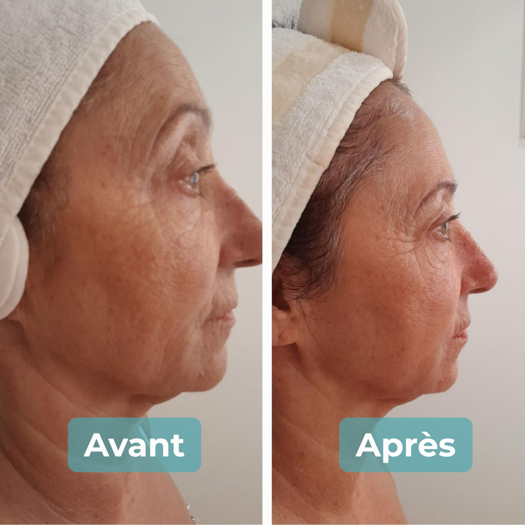 Avant/Après soin anti-âge MAbeautyplus