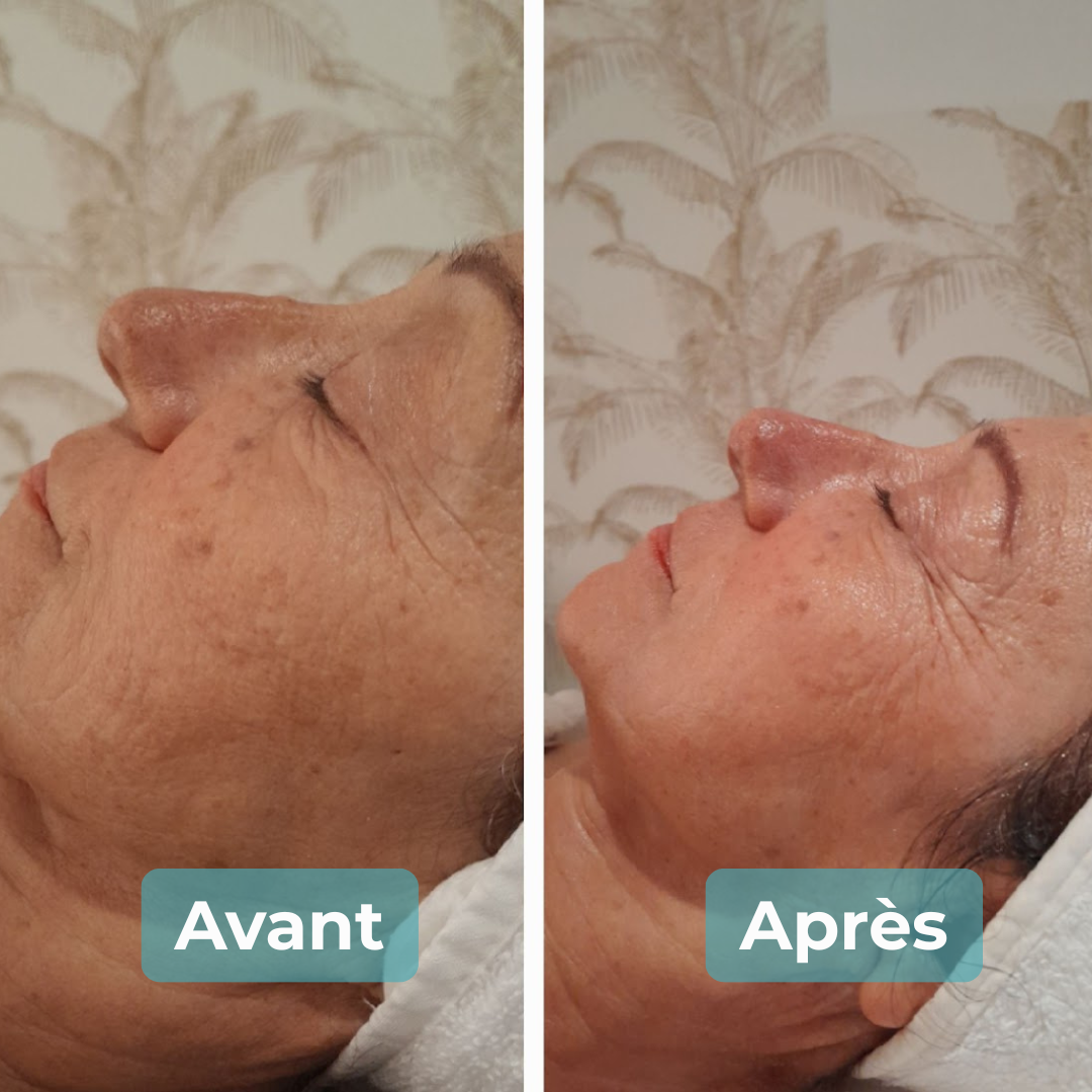 Avant/Après soin anti-âge MAbeautyplus
