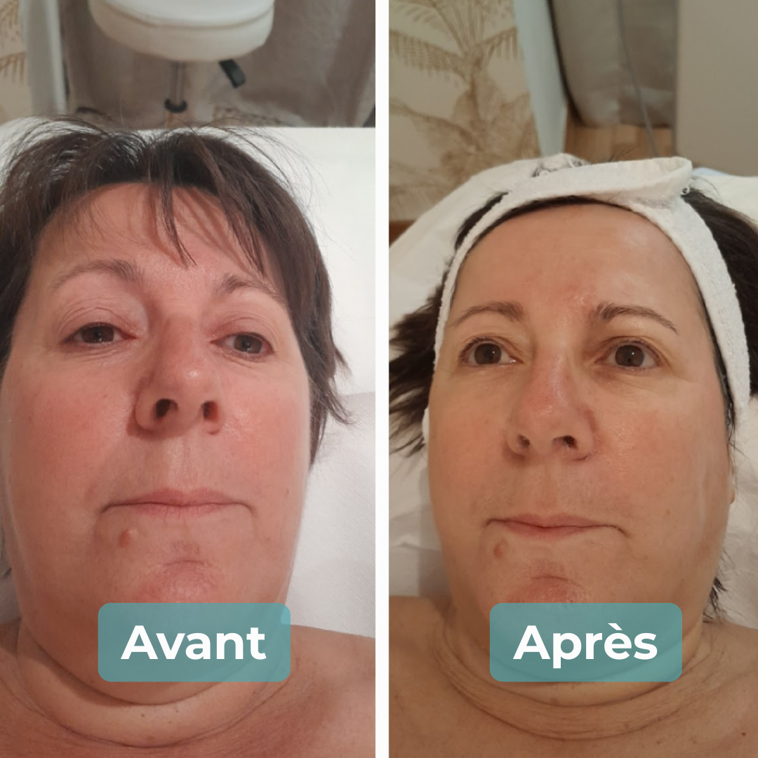Avant/Après soin anti-âge MAbeautyplus