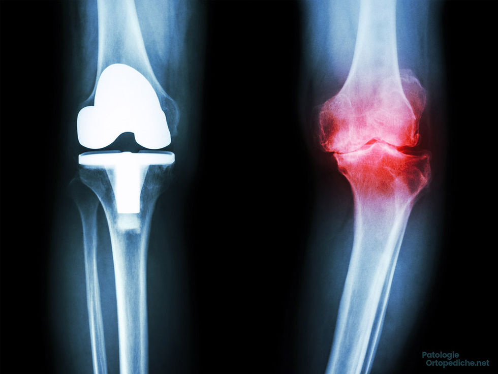 Genicular artery embolization (GAE): a minimally invasive treatment for knee osteoarthritis pain. Indications, technique, and clinical outcomes.