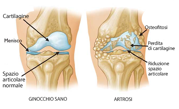 artrosi-ginocchio-.png