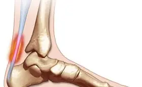 Embolizzazione del tendine d'Achille: un trattamento efficace e mini-invasivo per la tendinopatia cronica dell'achilleo.