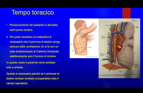 tempo toracico esofagectomai e linfoadenectomia
