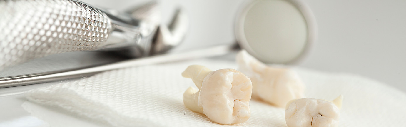 wisdom teeth removal