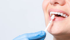 Veneers