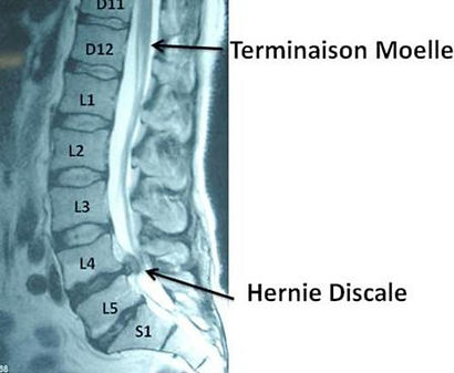 herniediscale.jpg