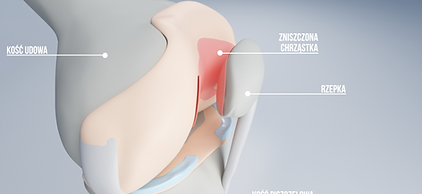 Chondromalacja rzepki rehabilitacja Warszawa - Fizjo-Orth 