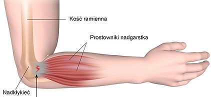 Łokieć tenisisty rehabilitacja Warszawa - Fizjo-Orth 