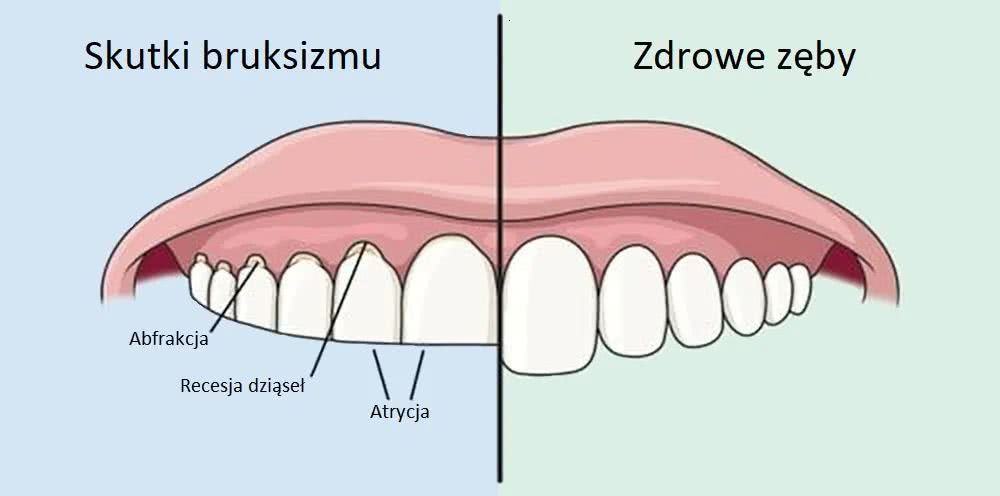 Skutki-Bruksizmu-Schemat.jpg